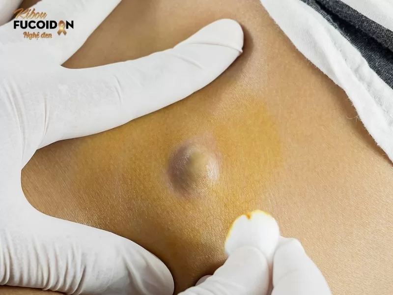 Bệnh u bã đậu, nguyên nhân, dấu hiệu và cách điều trị U bã đậu thường có kích thước từ nhỏ đến lớn, nằm nổi lên trên bề mặt da và cảm giác mềm mại.