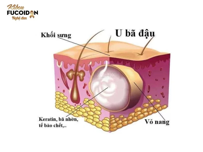 Bệnh u bã đậu, nguyên nhân, dấu hiệu và cách điều trị Hình ảnh mô phỏng u bã đậu
