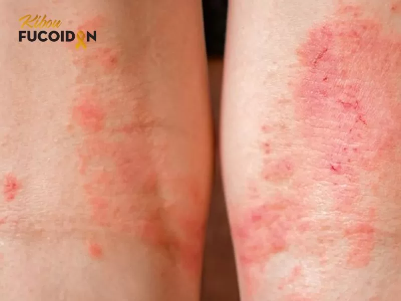 Hình ảnh minh họa viêm da do xạ trị Hình ảnh minh họa viêm da do xạ trị