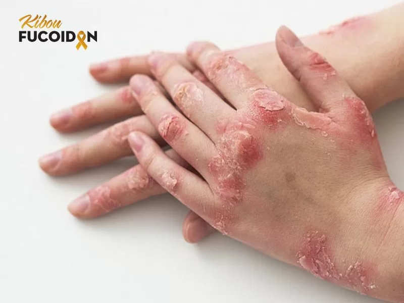 Một số trường hợp xạ trị có thể gây loét da Một số trường hợp xạ trị có thể gây loét da
