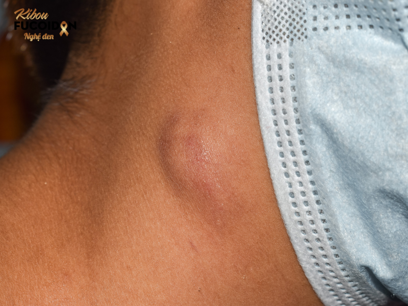 Cách dùng Fucoidan cho bệnh nhân ung thư hạch Ung thư hạch (hay còn gọi là lymphoma) là một nhóm bệnh ung thư xuất phát từ hệ bạch huyết
