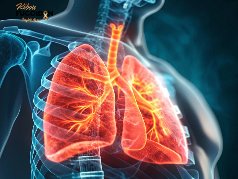 Ung thư phổi là gì? Dấu hiệu và cách điều trị Ung thư phổi là loại ung thư phát sinh từ mô phổi, thường bắt đầu từ các tế bào biểu mô của phế quản hoặc phế nang