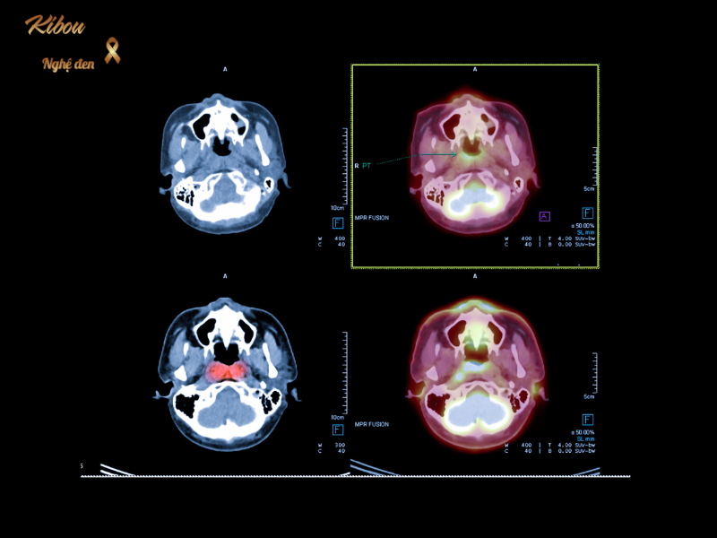ĐAU HỌNG, Ù TAI KÉO DÀI MÙA LẠNH: CẢNH GIÁC UNG THƯ VÒM HỌNG Ung thư vòm họng thường khó nhận biét