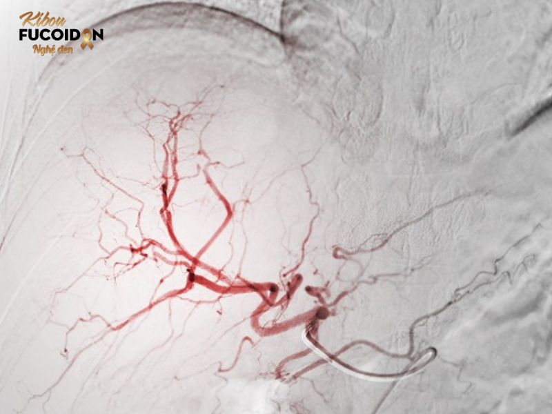 UNG THƯ GAN CÓ CHỮA ĐƯỢC KHÔNG? CÂU HỎI LỚN MÙA TIỆC TÙNG Nút mạch ung thư gan