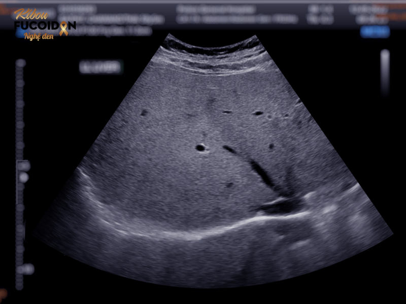 UNG THƯ GAN CÓ CHỮA ĐƯỢC KHÔNG? CÂU HỎI LỚN MÙA TIỆC TÙNG Siêu âm chẩn đoán ung thư gan